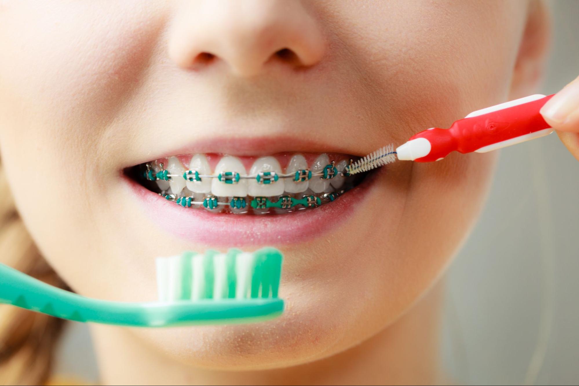 A Guide for Oral Hygiene with Braces
